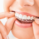 Illustration for article titled Invisalign Dental Treatment- Processem/em